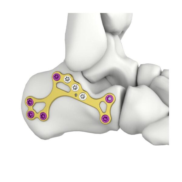 跟骨微创锁定接骨板（Itval Calcaneal MIS Locking Plate）