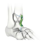 Plat Penguncian Fusi Pergelangan Kaki MIS