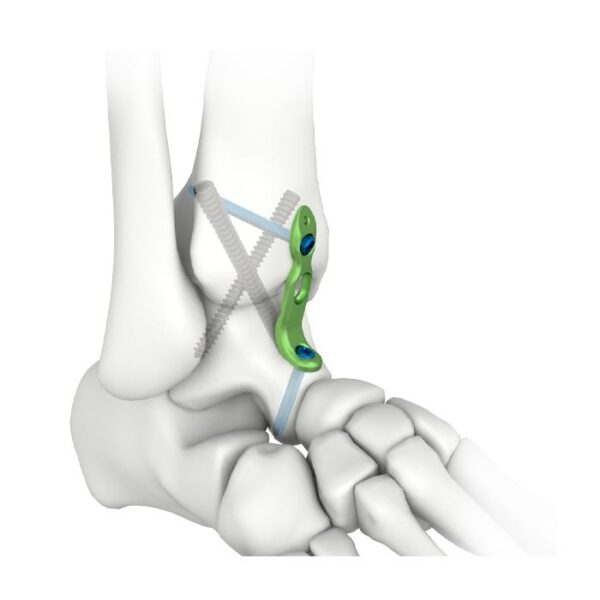 Plat Penguncian Fusi Pergelangan Kaki MIS