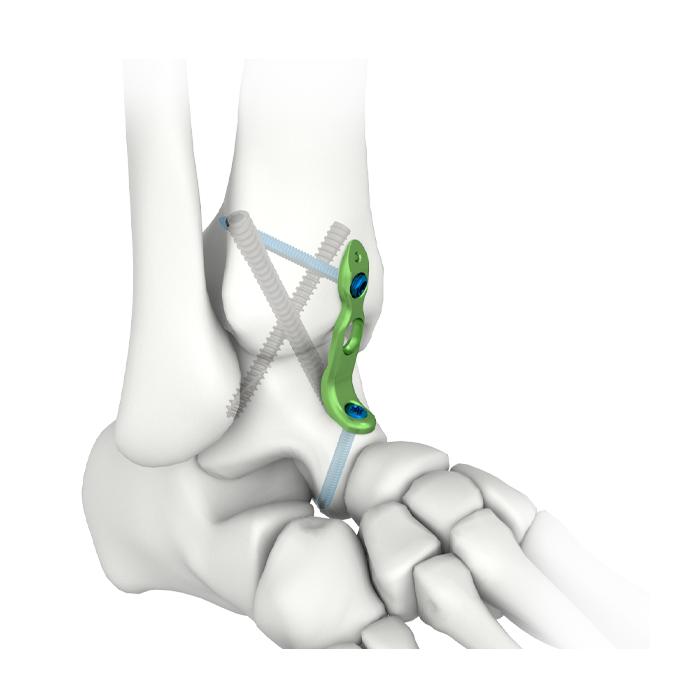 Plat Penguncian Fusi Pergelangan Kaki MIS