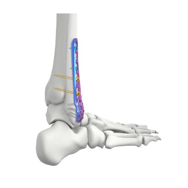 PLAT KUNCI FIBULAR LATERAL DISTAL VAL