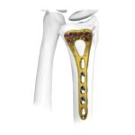 Plat Penguncian Radius Distal Ⅰ