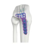 PLAT PENGEKANG DR TIBIA LATERAL PROKSIMAL VAL