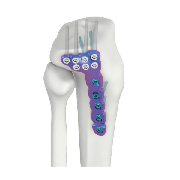 PLAT PENGEKANG DR TIBIA LATERAL PROKSIMAL VAL