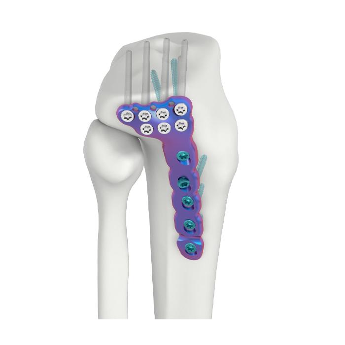 PLAT PENGEKANG DR TIBIA LATERAL PROKSIMAL VAL