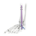 Ankle Arthrodesis Nail
