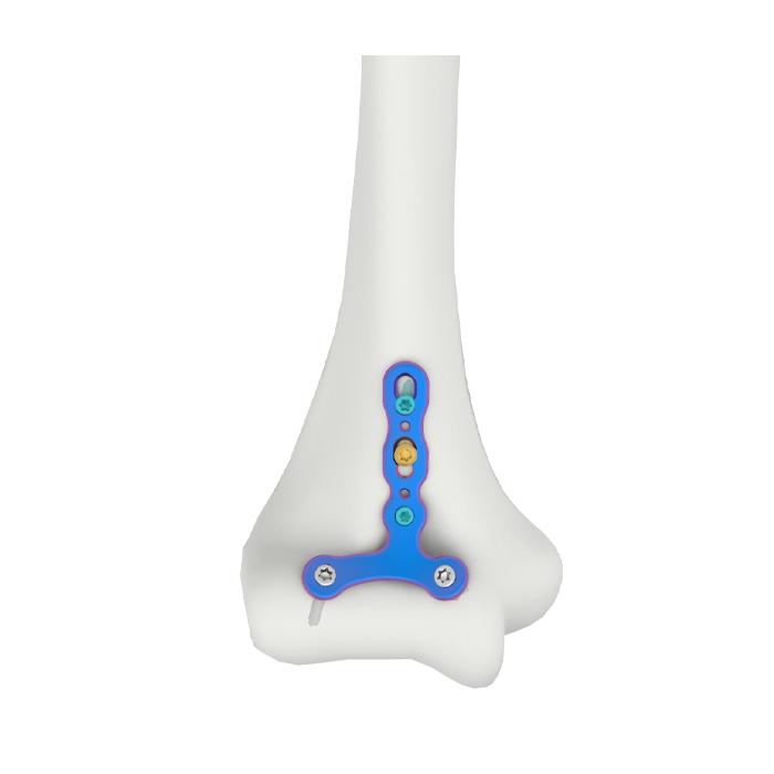 PLAT PENGGANTUNG CAPITELLUM TROCHLEA HUMERAL