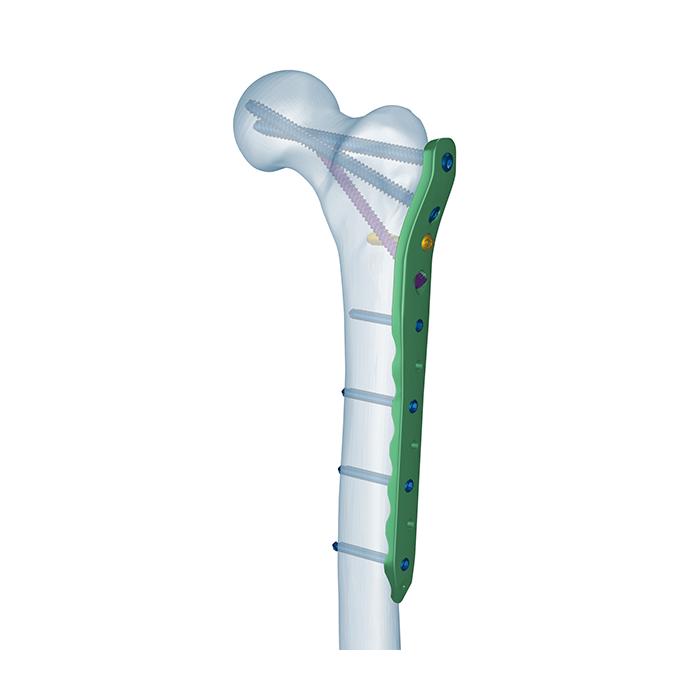 Plat Penguncian Femur Proksimal
