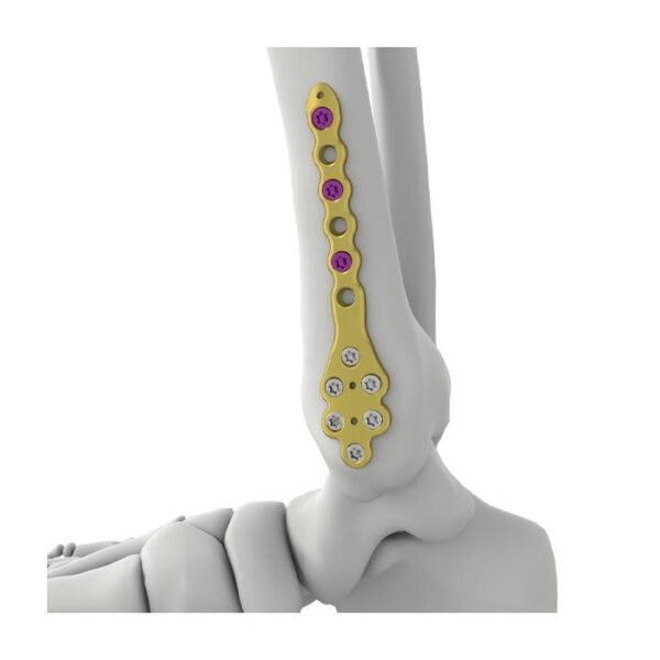 Plat Penguncian Tibia Medial Distal Itval