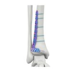 PLAT PENGGANTUNG TIBIA LATERAL ANTERIOR DISTAL