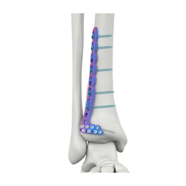 PLAT PENGGANTUNG TIBIA LATERAL ANTERIOR DISTAL