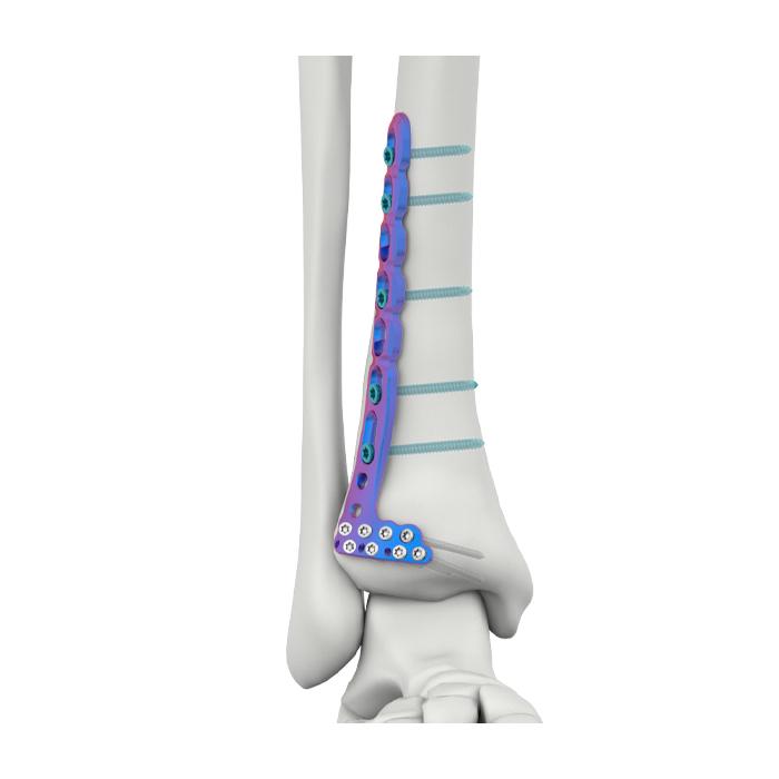 PLAT PENGGANTUNG TIBIA LATERAL ANTERIOR DISTAL