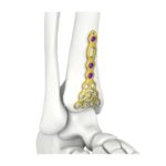 Plat Penguncian Tibia Anterior Distal Itval