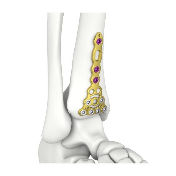 Plat Penguncian Tibia Anterior Distal Itval