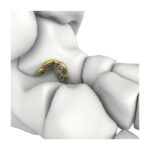 Plat Penguncian Itval Talus