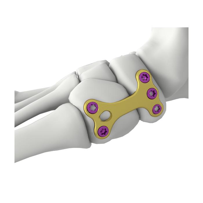 Plat Penguncian Fusi Cuniform Navicular Itval