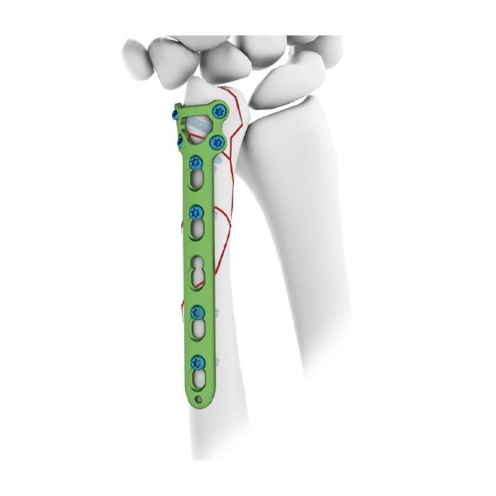 Plat Penguncian Ulnar Distal