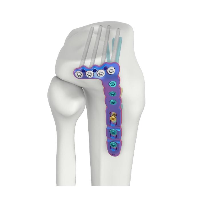 VAL Plat Penguncian SR Tibia Lateral Proksimal Belakang