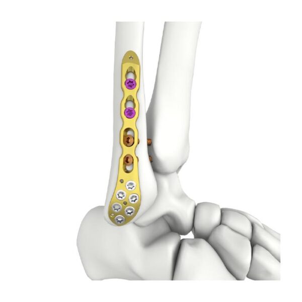Plat Penguncian Fibula Lateral Distal Itval