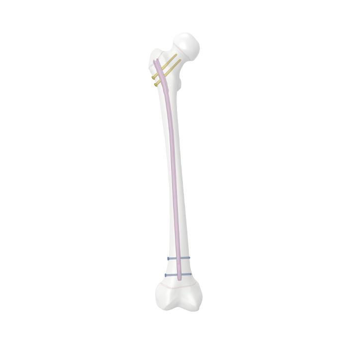 Sistem paku femur remaja